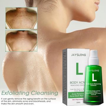 Acne Treatment Pimple Remover - Buy 1 Get 1 Free
